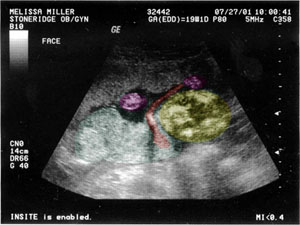 our second ultrasound, in color